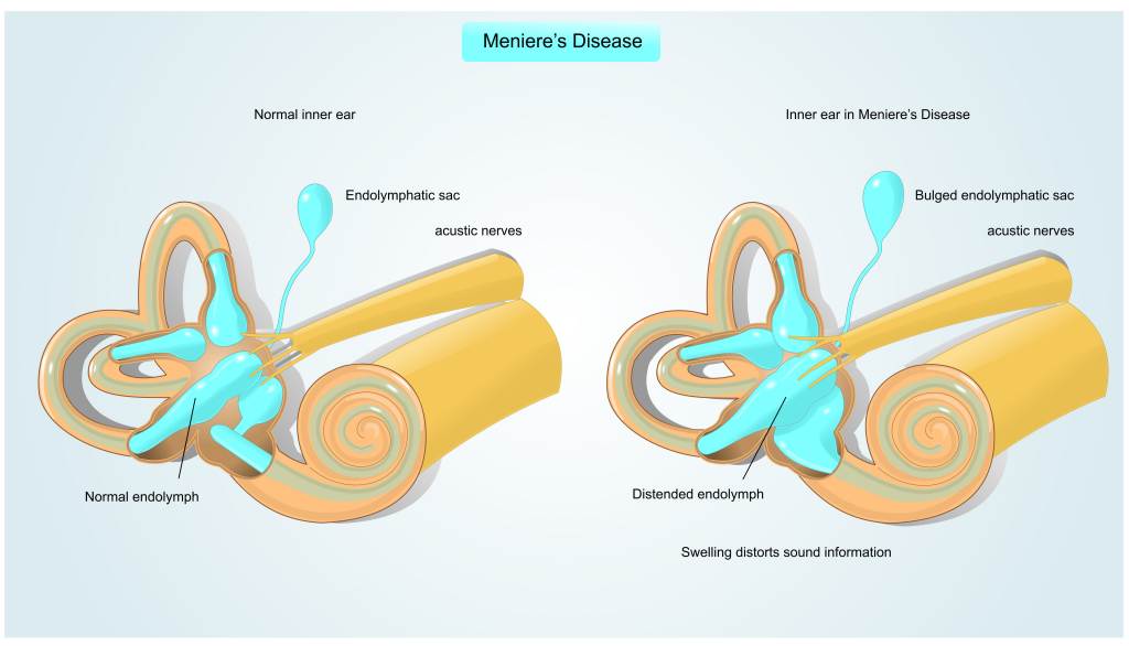 Detail Gambar Penyakit Meniere Nomer 3