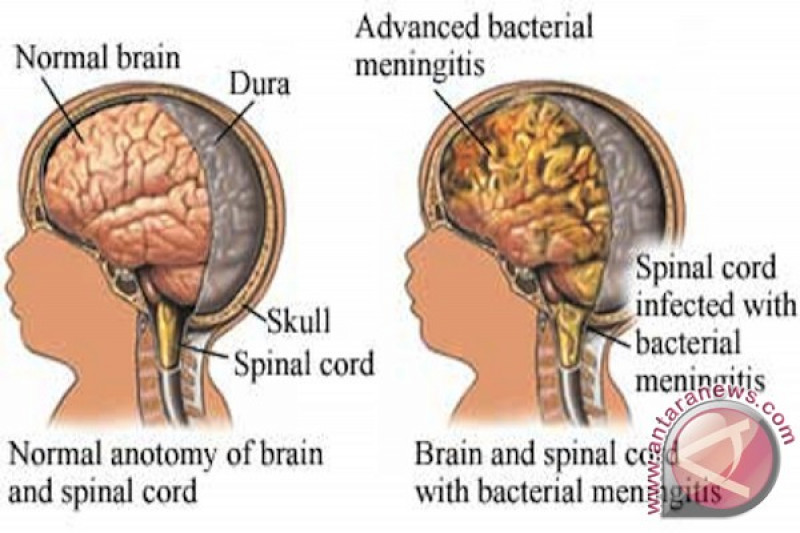 Detail Gambar Penyakit Meningitis Nomer 3