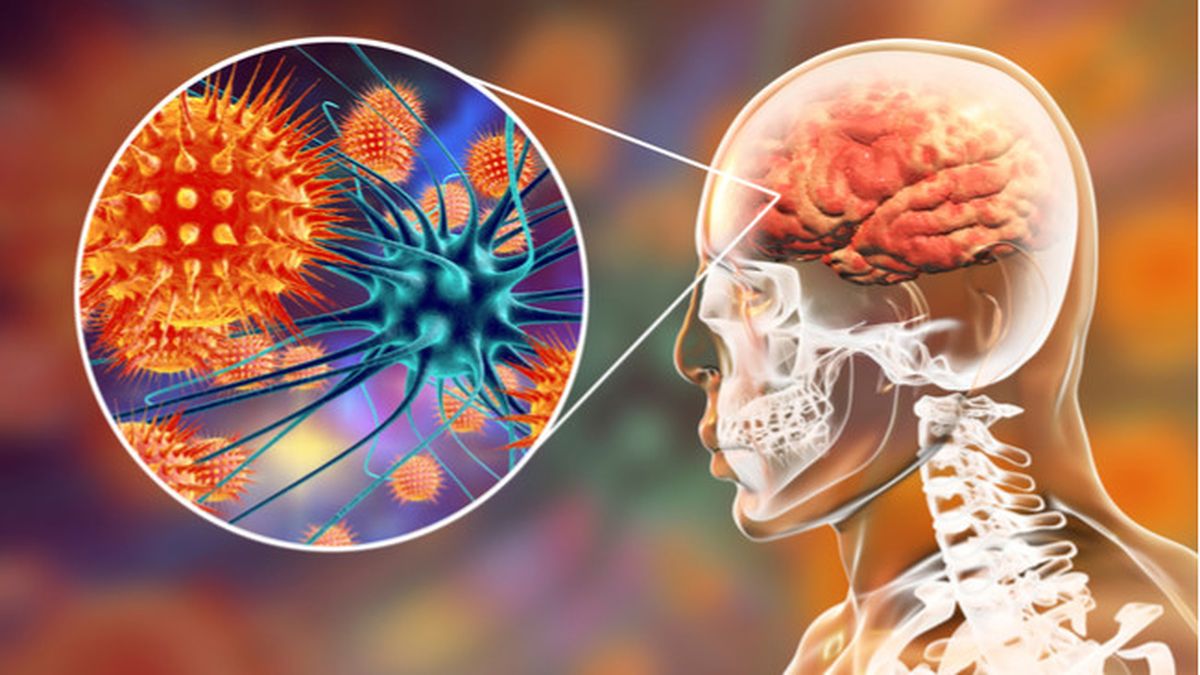 Detail Gambar Penyakit Meningitis Nomer 4