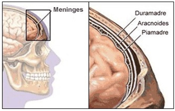 Detail Gambar Penyakit Meningitis Nomer 35