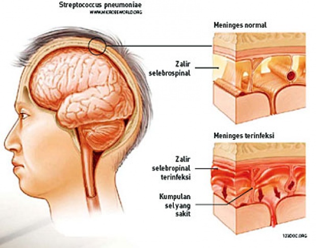 Detail Gambar Penyakit Meningitis Nomer 7