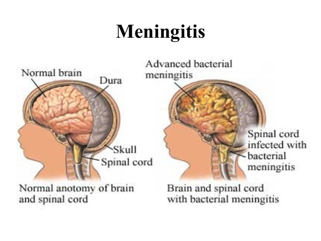 Detail Gambar Penyakit Meningitis Nomer 9