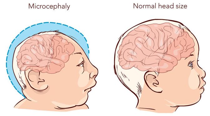 Detail Gambar Penyakit Mikrosefalus Nomer 2