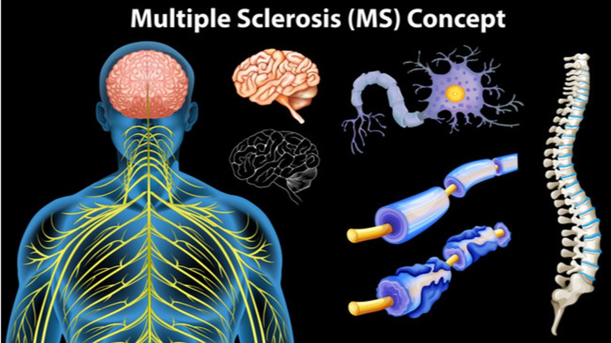 Detail Gambar Penyakit Multiple Sclerosis Nomer 2