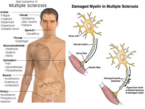 Detail Gambar Penyakit Multiple Sclerosis Nomer 11