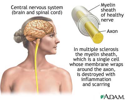 Detail Gambar Penyakit Multiple Sclerosis Nomer 12