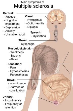 Detail Gambar Penyakit Multiple Sclerosis Nomer 13