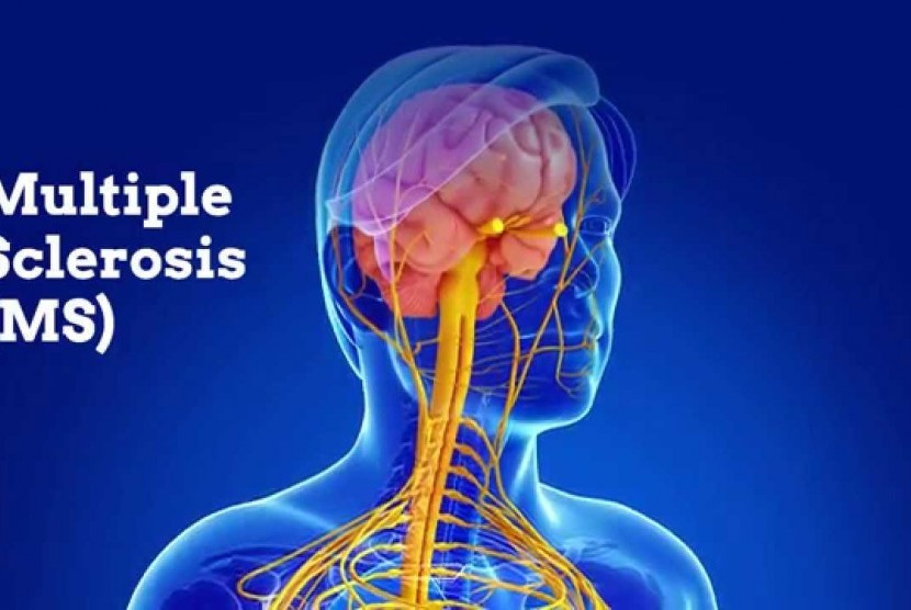 Detail Gambar Penyakit Multiple Sclerosis Nomer 14