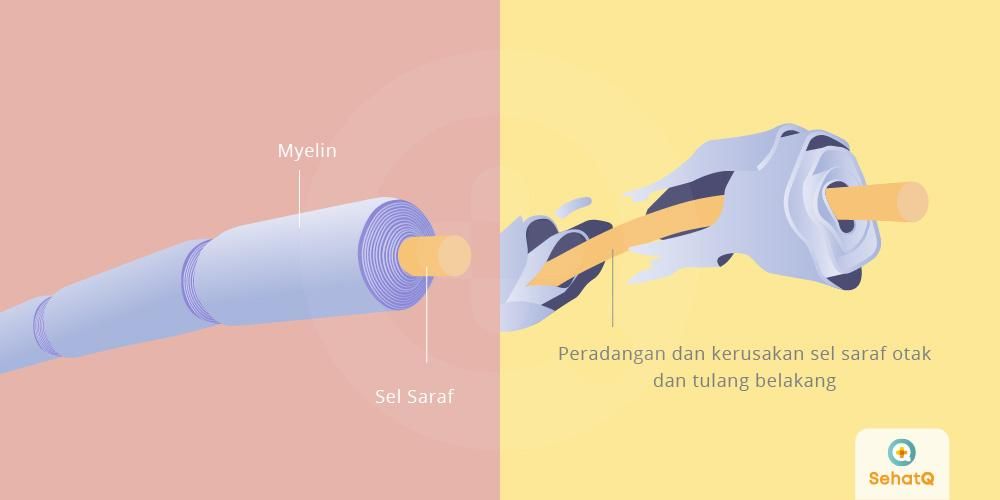 Detail Gambar Penyakit Multiple Sclerosis Nomer 26