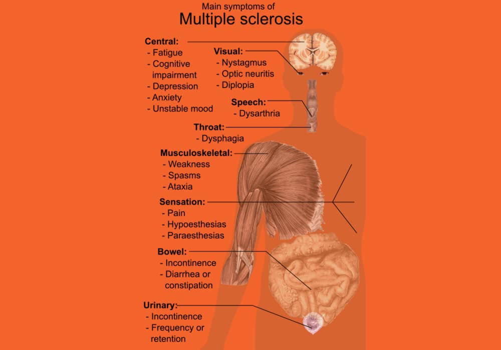 Detail Gambar Penyakit Multiple Sclerosis Nomer 32