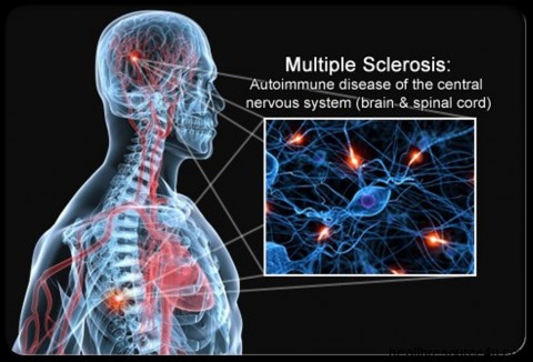 Detail Gambar Penyakit Multiple Sclerosis Nomer 5