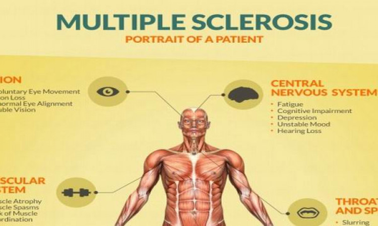 Detail Gambar Penyakit Multiple Sclerosis Nomer 6