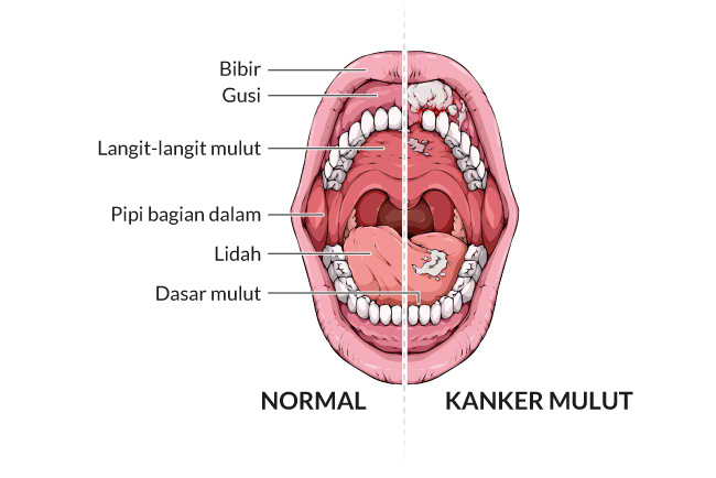 Detail Gambar Penyakit Mulut Nomer 2