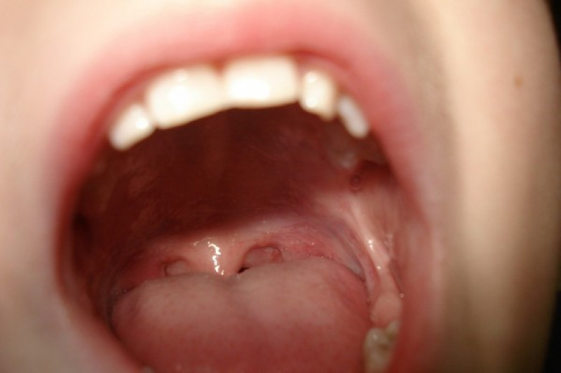 Detail Gambar Penyakit Mulut Nomer 10