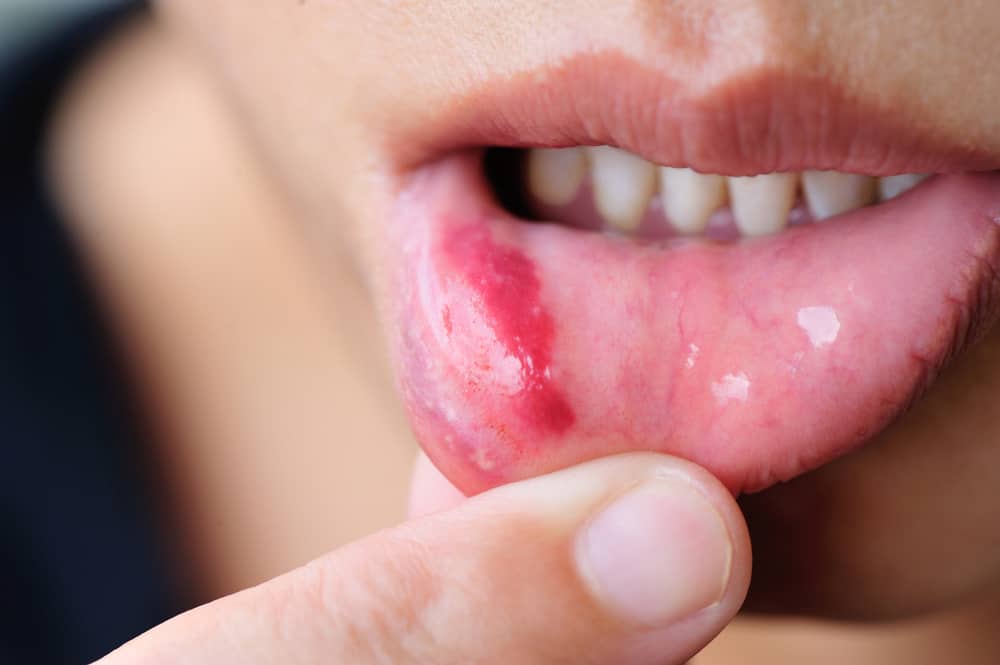 Detail Gambar Penyakit Mulut Nomer 14