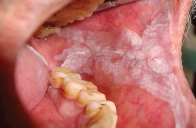 Detail Gambar Penyakit Mulut Nomer 19