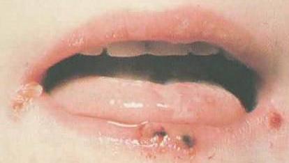 Detail Gambar Penyakit Mulut Nomer 22