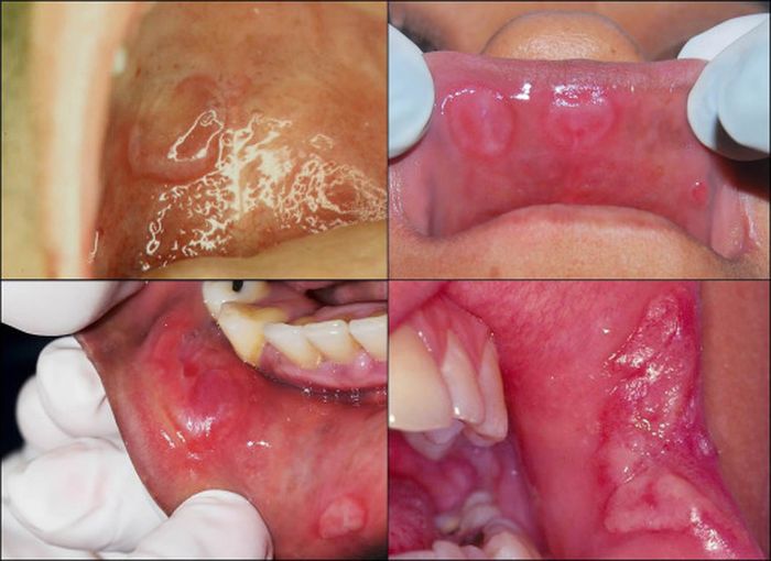 Detail Gambar Penyakit Mulut Nomer 23