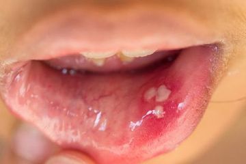 Detail Gambar Penyakit Mulut Nomer 43