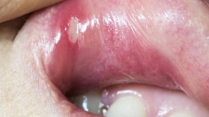 Detail Gambar Penyakit Mulut Nomer 44