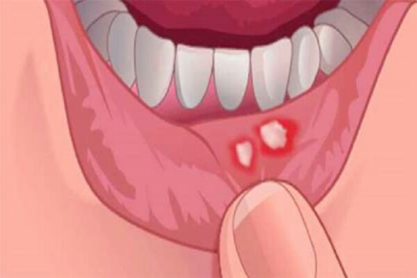 Detail Gambar Penyakit Mulut Nomer 45