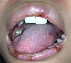 Detail Gambar Penyakit Mulut Nomer 8