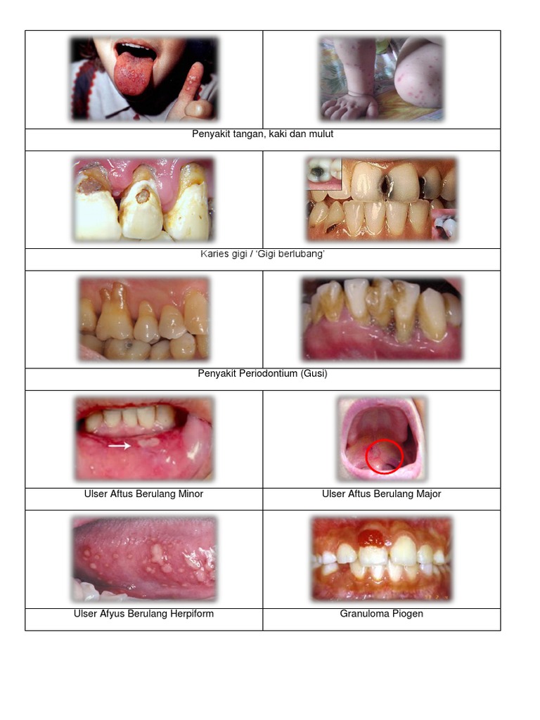 Detail Gambar Penyakit Mulut Nomer 9