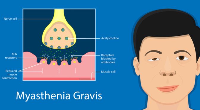 Gambar Penyakit Myasthenia Gravis - KibrisPDR