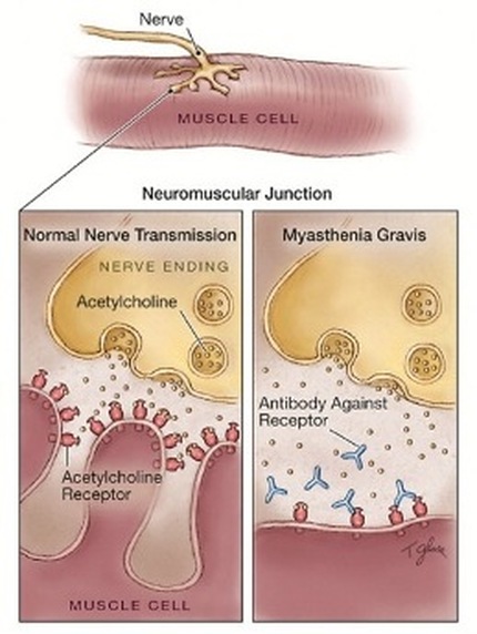 Detail Gambar Penyakit Myasthenia Gravis Nomer 14