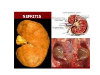 Detail Gambar Penyakit Nefritis Nomer 6