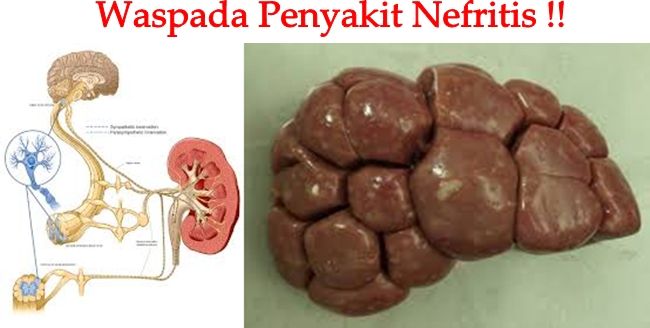 Detail Gambar Penyakit Nefritis Nomer 44