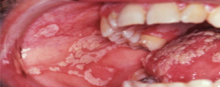 Detail Gambar Penyakit Oral Candidosis Nomer 21