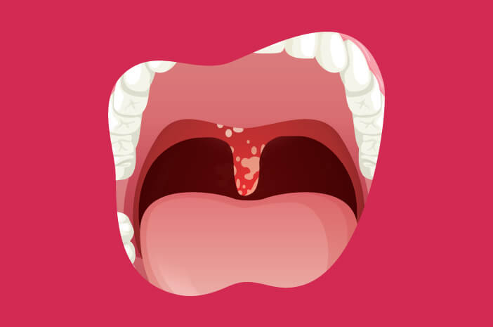 Detail Gambar Penyakit Oral Candidosis Nomer 26