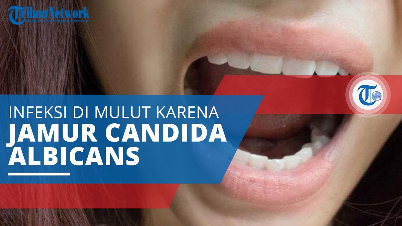 Detail Gambar Penyakit Oral Candidosis Nomer 30