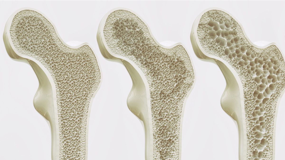Gambar Penyakit Osteoporosis - KibrisPDR