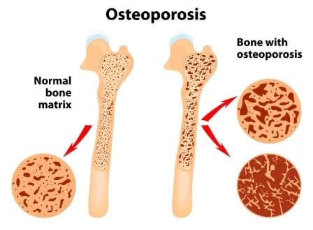 Detail Gambar Penyakit Osteoporosis Nomer 13