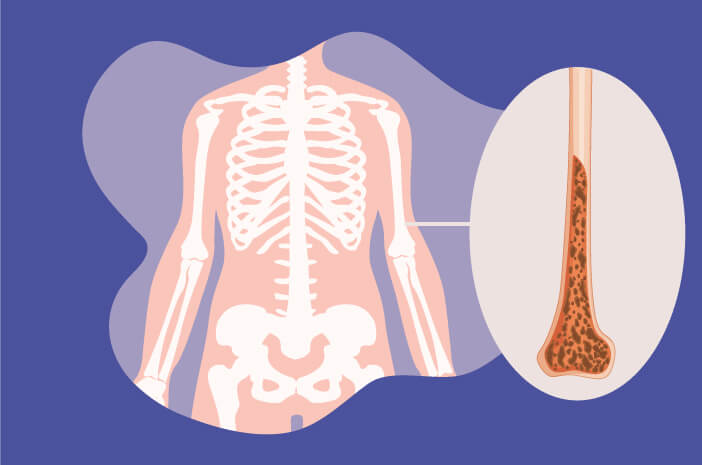 Detail Gambar Penyakit Osteoporosis Nomer 15