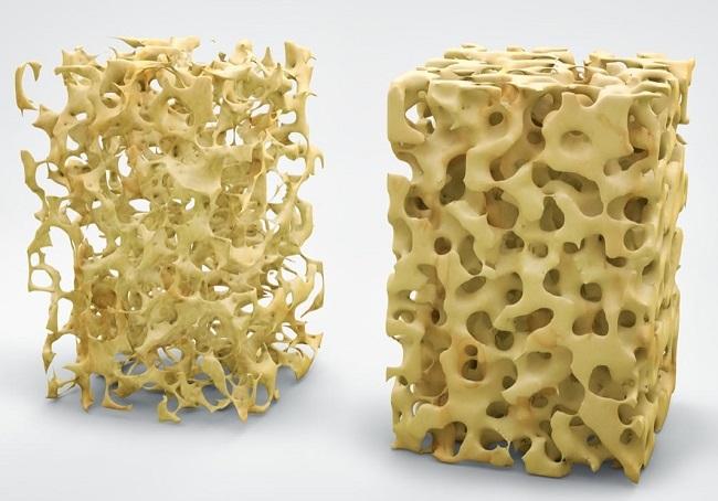 Detail Gambar Penyakit Osteoporosis Nomer 46