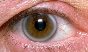 Detail Gambar Penyakit Pada Mata Nomer 43