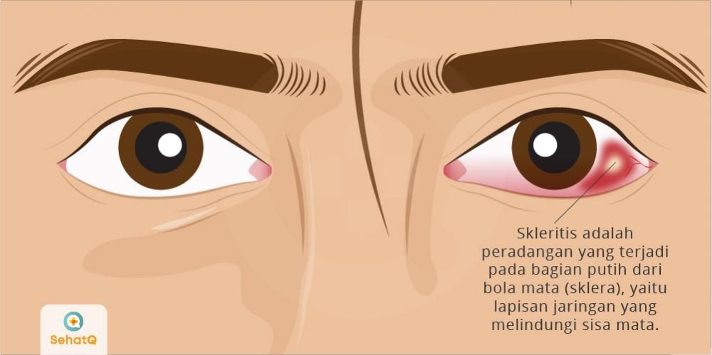 Detail Gambar Penyakit Pada Mata Nomer 46