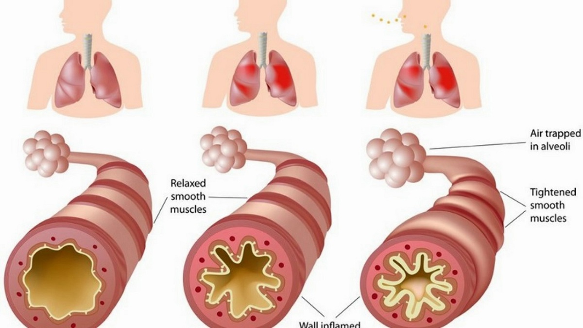 Detail Gambar Penyakit Paru Nomer 18