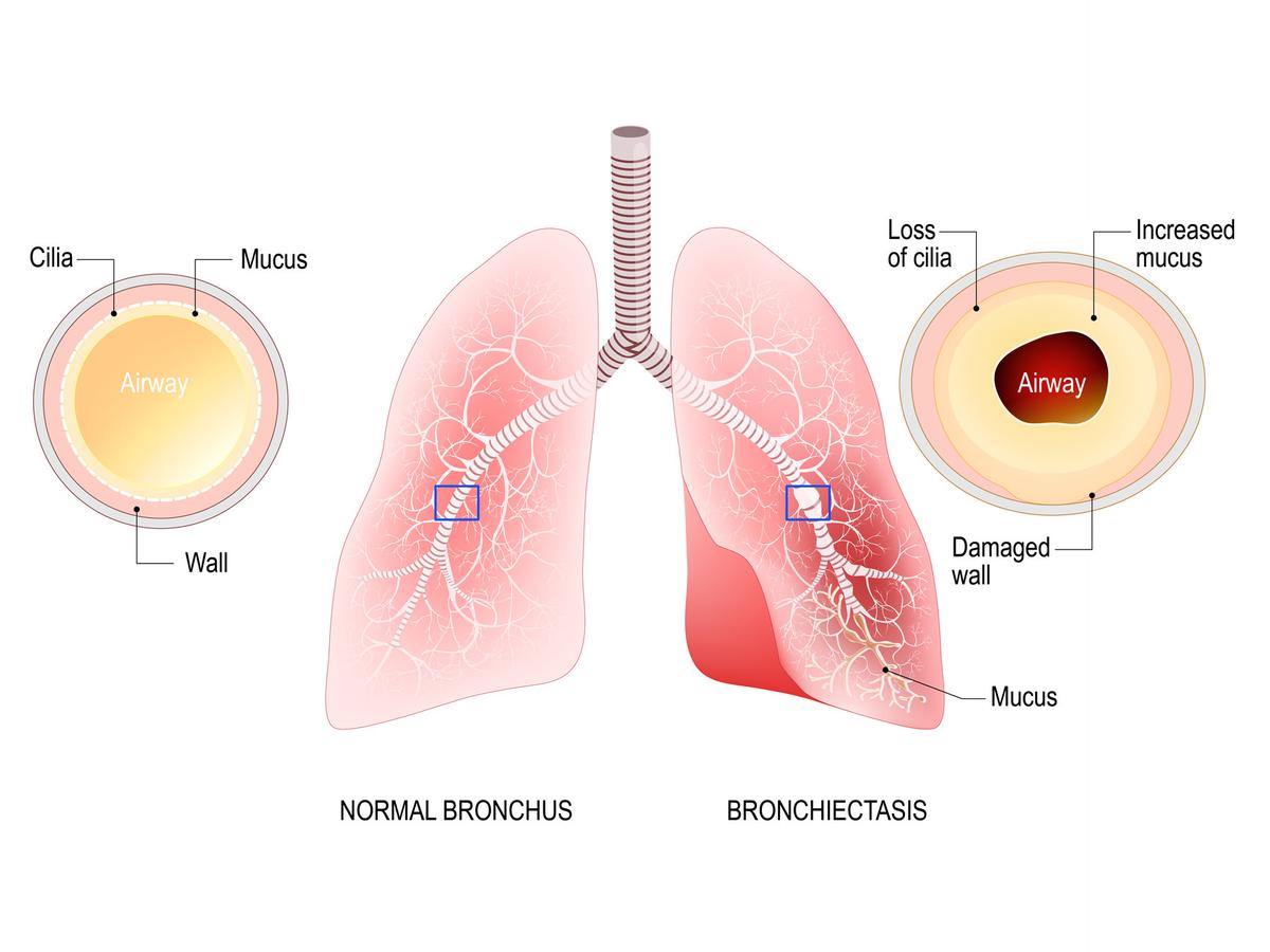 Detail Gambar Penyakit Paru Nomer 7