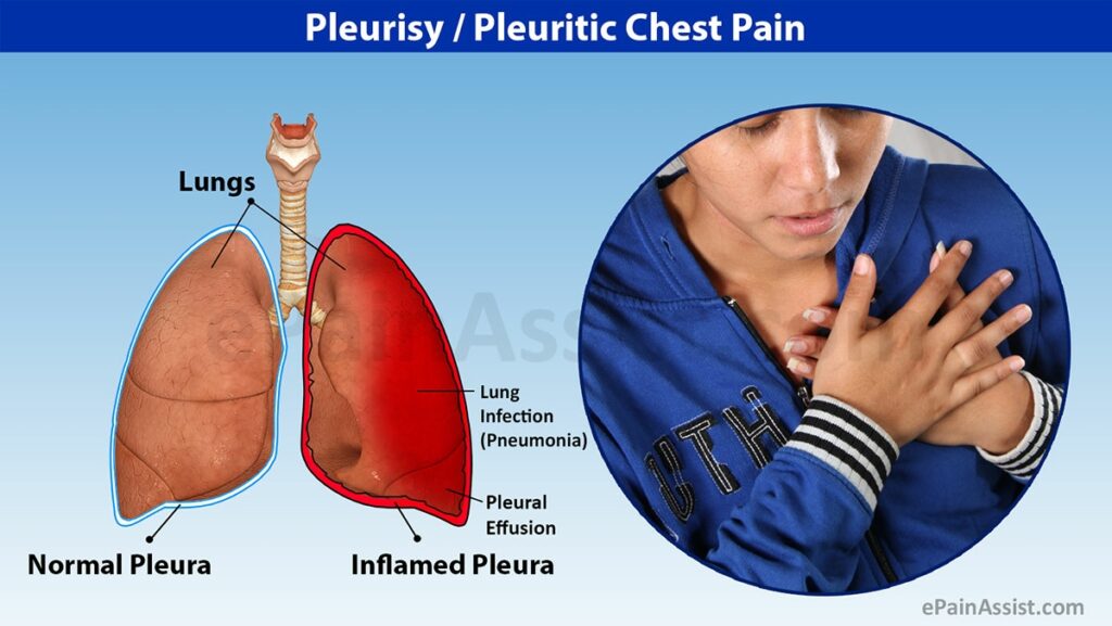 Detail Gambar Penyakit Pleuritis Nomer 10