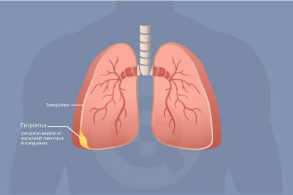 Detail Gambar Penyakit Pleuritis Nomer 15