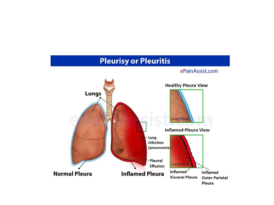 Detail Gambar Penyakit Pleuritis Nomer 26