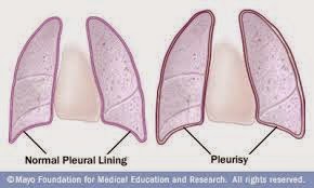 Detail Gambar Penyakit Pleuritis Nomer 6