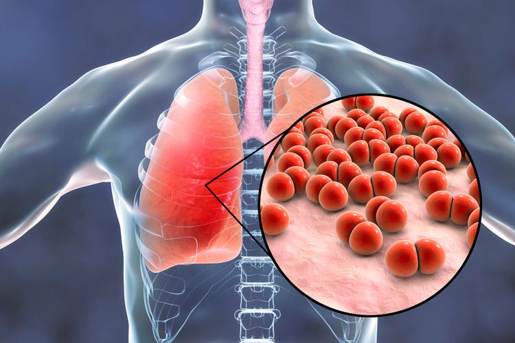 Detail Gambar Penyakit Pneumonia Nomer 2