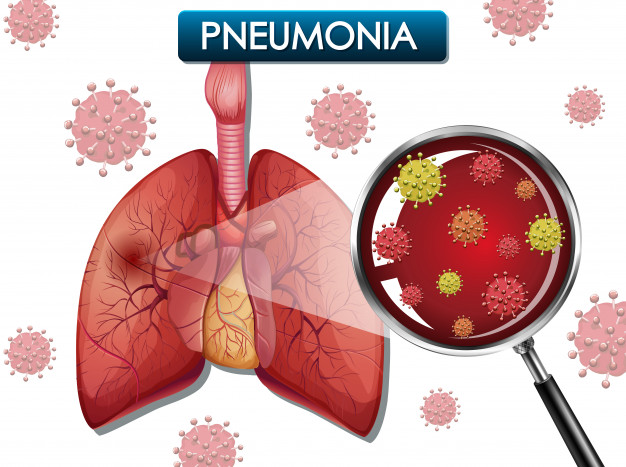Detail Gambar Penyakit Pneumonia Nomer 15