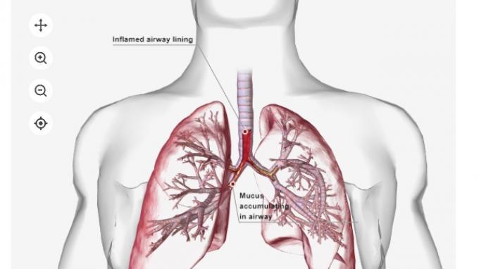 Detail Gambar Penyakit Pneumonia Nomer 3