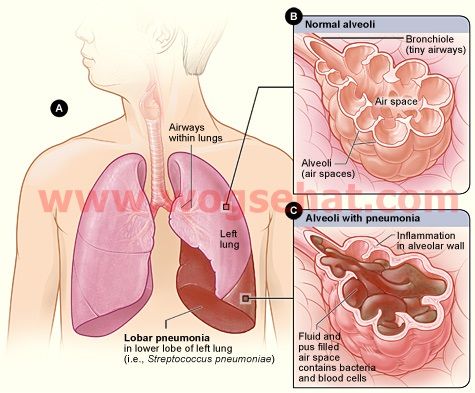 Detail Gambar Penyakit Pneumonia Nomer 30
